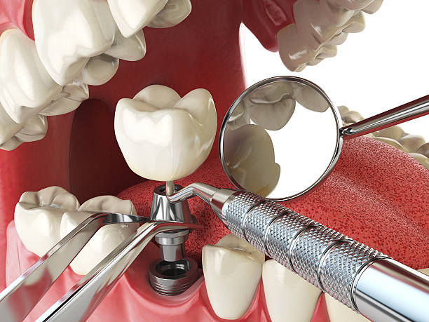 Best Emergency Wisdom Tooth Extraction in Magee, MS
